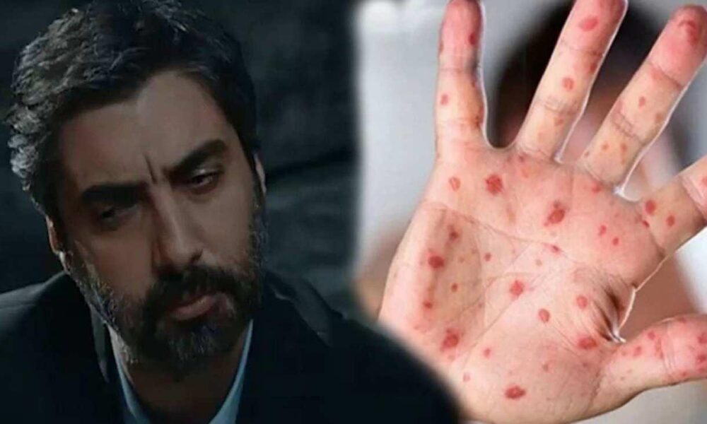 Kurtlar Vadisi dizisinde Maymun çiçeği virüsü sahnesi gündem oldu!Meğer 10 yıl önce anlatmışlar