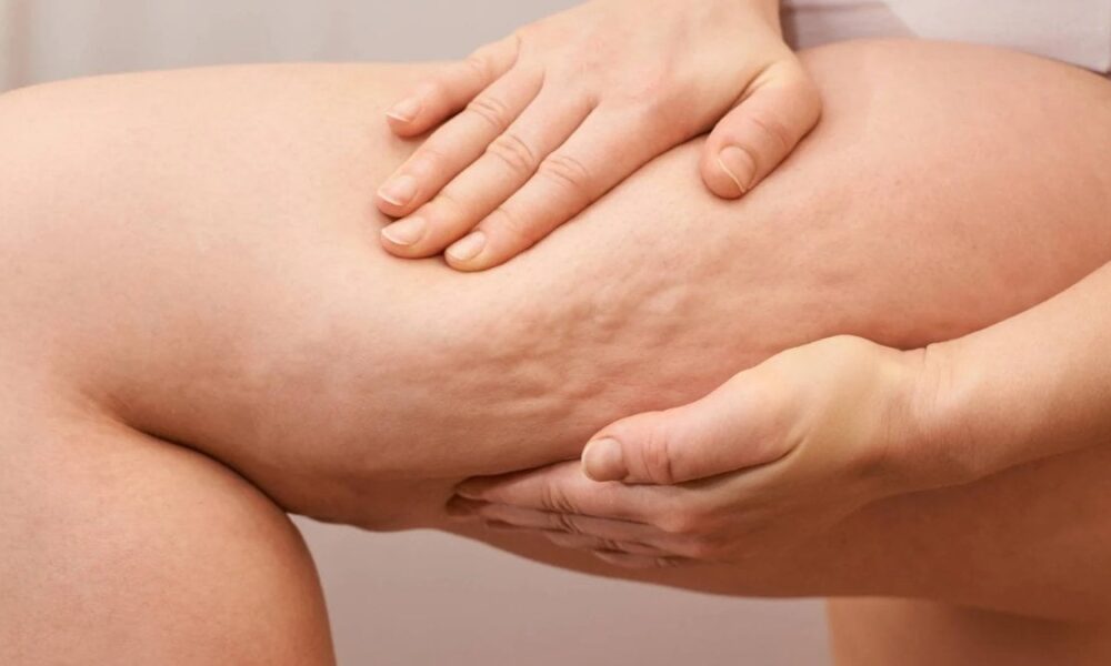 Selülit gibi görünen “lipödem” nedir, nasıl anlaşılır?