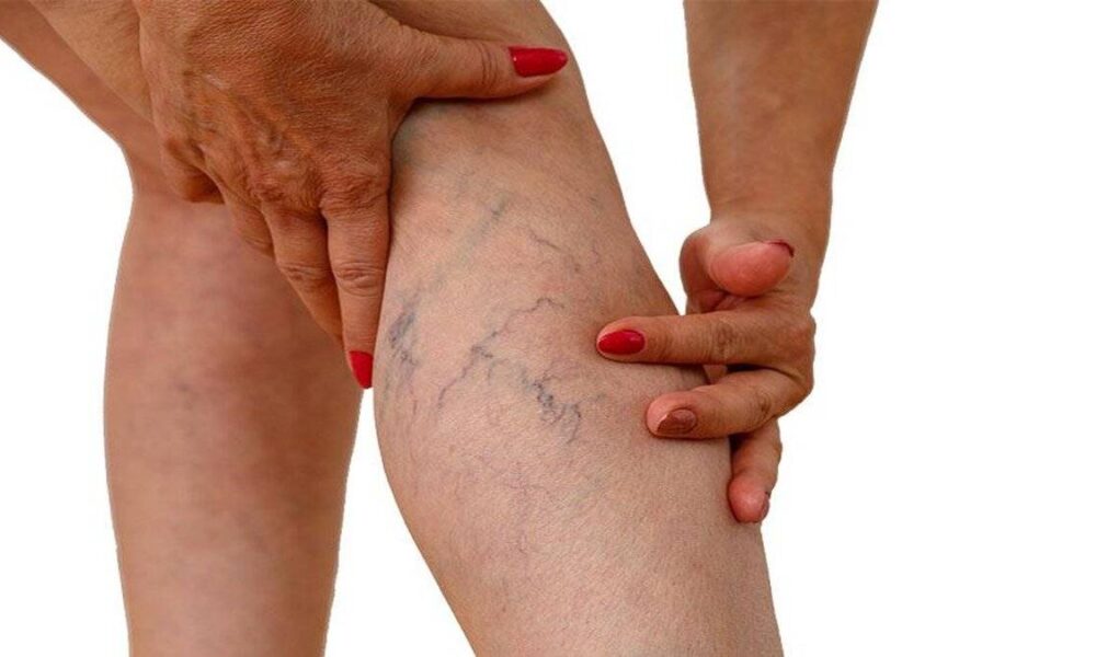 Bacaklarınıza iyi bakın! Varislerden korunmanın 7 etkili yolu