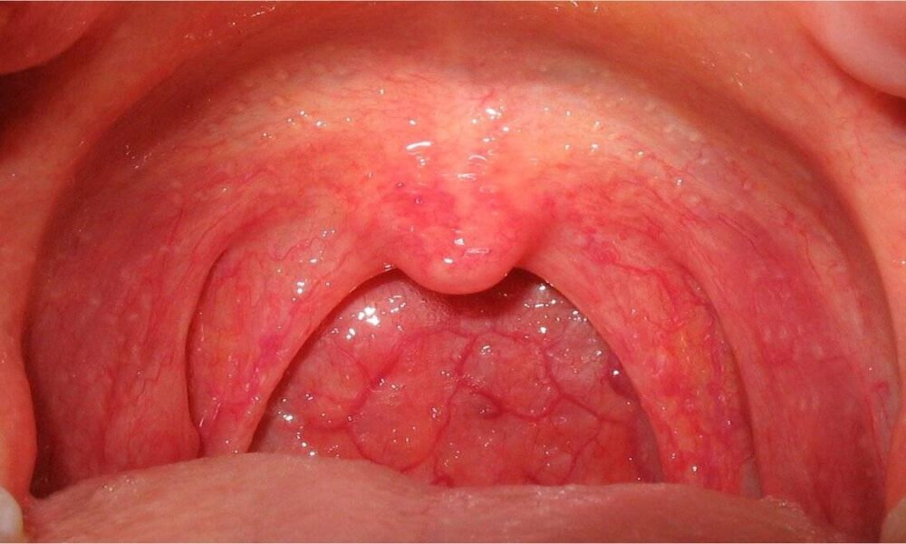 Boğaz ağrısının gerisindeki zımnî tehdit: Faranjit