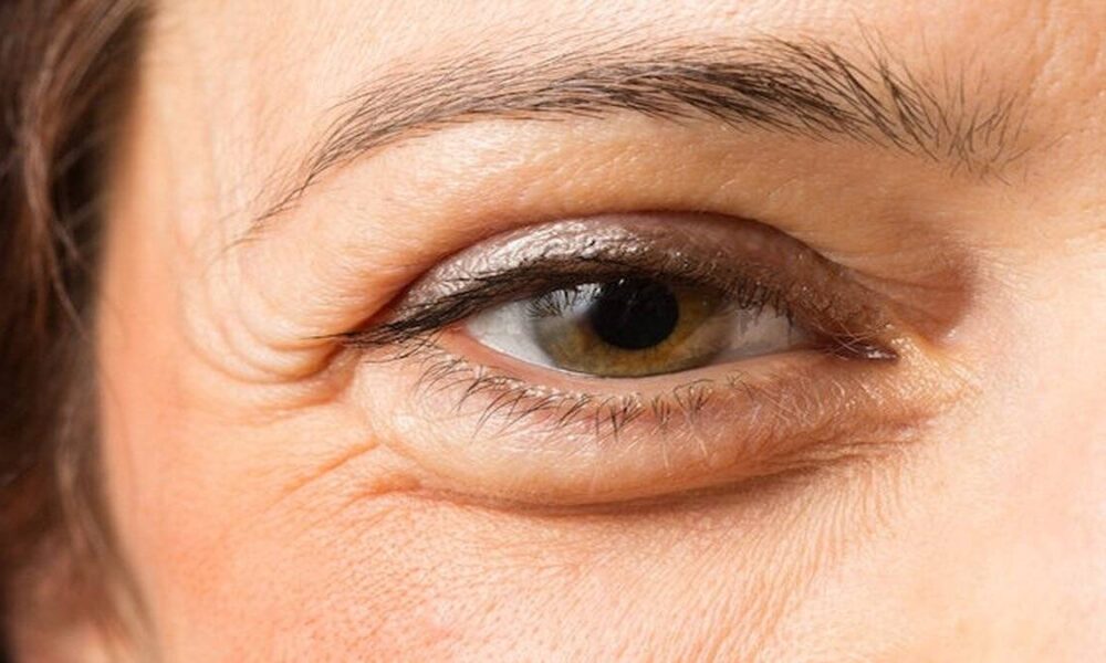 Göz altı torbalarından kurtulmanın 7 tesirli yolu