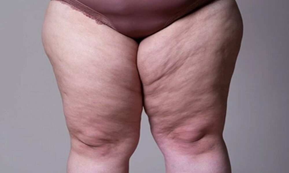 Lipödem nedir, nasıl anlaşılır?
