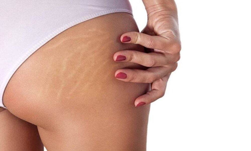 Selüliti önlemenin 5 tesirli yolu