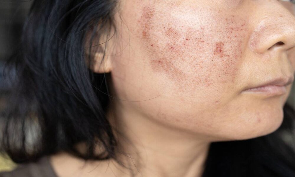 Sivilce izlerinden güneş lekelerine tahlil: Leke protokolü