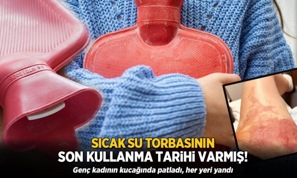sicak-su-torbasinin-son-kullanma-tarihi-varmis-genc-kadinin-kucaginda-patladi-her-yeri-yandi-SHvnqCff.jpg