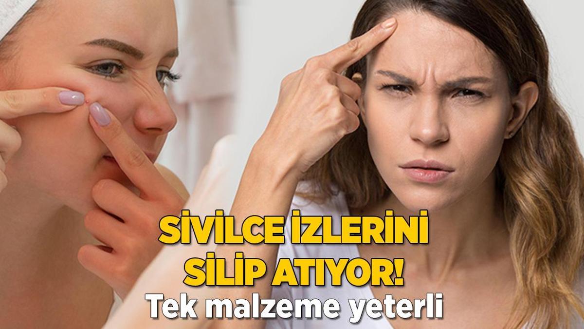 Sivilce izlerini tekte silip atıyormuş! Tek malzemede mucize etki