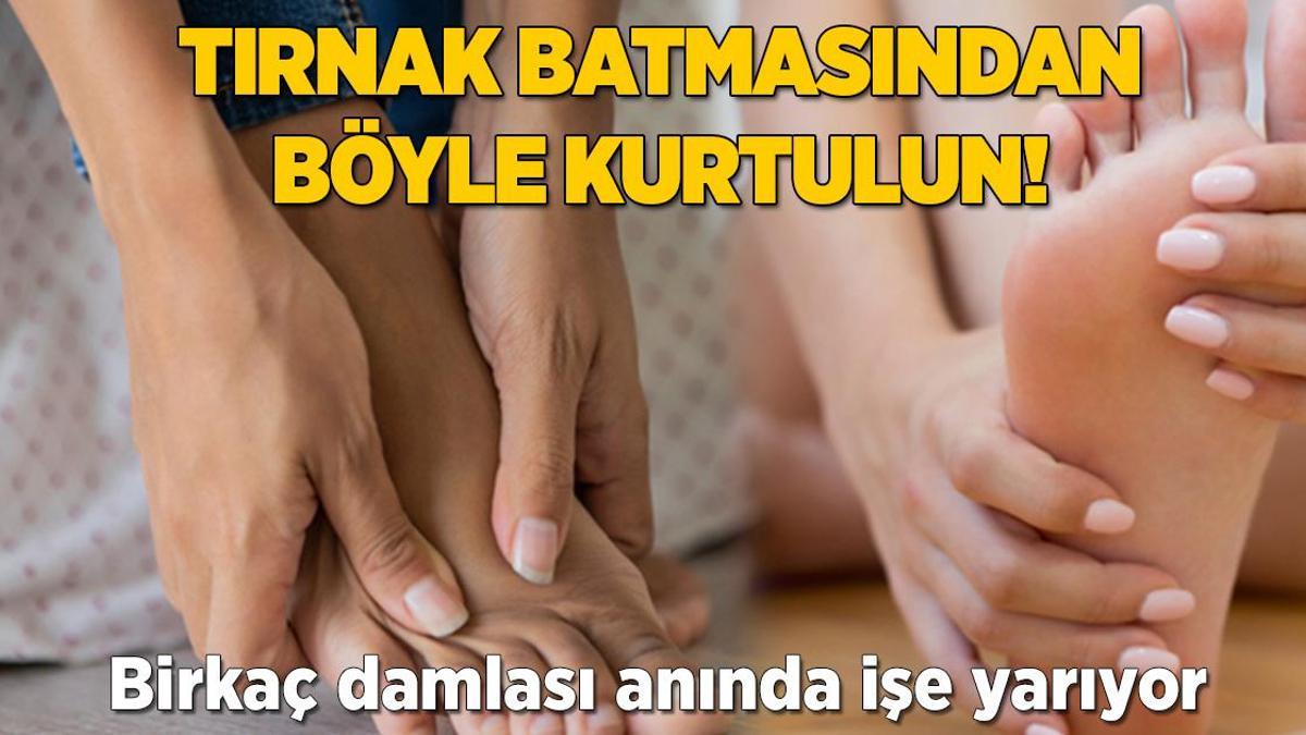 Tırnak batmasından böyle kurtulun! Birkaç damlası anında işe yarıyor
