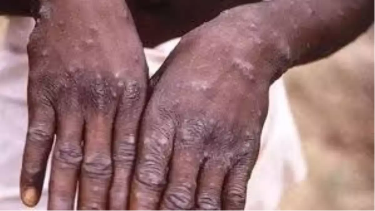 Zimbabve ve Zambiya’da Maymun Çiçeği Vaka Sayısı Arttı